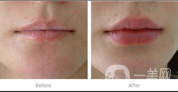 自體脂肪豐唇貴嗎,自體脂肪豐唇價(jià)格