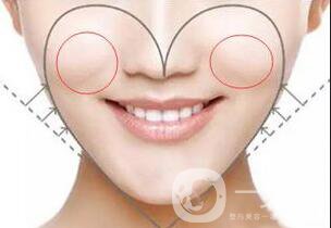 自體脂肪豐蘋(píng)果肌貴嗎 