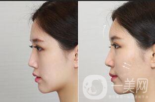 豐蘋果肌貴嗎,豐蘋果肌價格