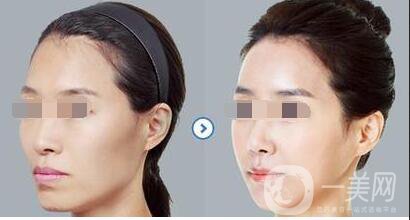 自體脂肪面部填充貴嗎