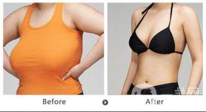 乳房縮小會留疤嗎,乳房縮小多久恢復(fù)