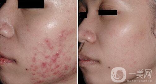 果酸換膚多少錢,果酸換膚價(jià)格