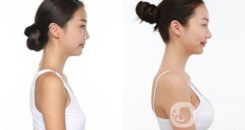 乳房下垂矯正手術(shù)貴嗎 乳房下垂矯正的方法