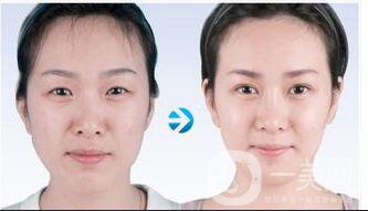 上海削骨多少錢,上海削骨費用