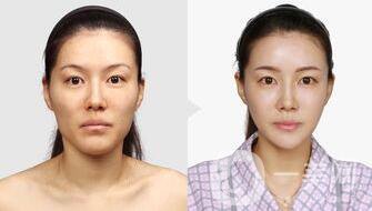 面部自體脂肪填充貴嗎,面部自體脂肪填充多少錢