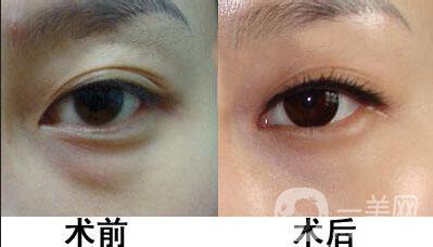 超聲法去眼袋價格,超聲法去眼袋術(shù)后護(hù)理