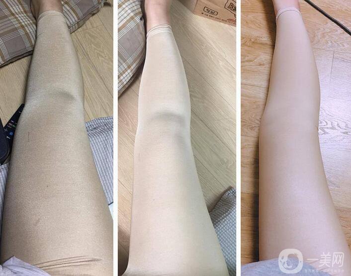 小腿吸脂的價(jià)格介紹附真人*果反饋