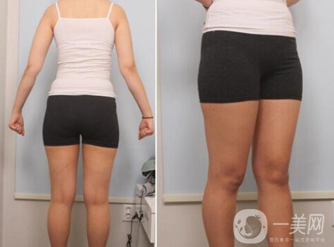 小腿吸脂價(jià)格,小腿吸脂真人*果反饋