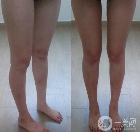小腿吸脂價(jià)格,小腿吸脂真人*果反饋