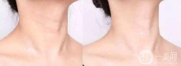 有頸紋怎么辦 調(diào)節(jié)頸紋的方法有哪些