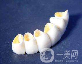 美容冠多少錢 美容冠*果好不好