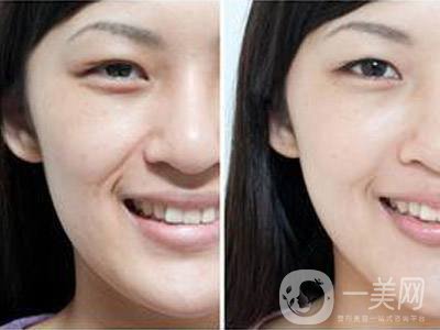 自體脂肪填充法令紋貴嗎 去法令紋的*果好不好