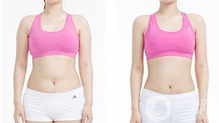 腹部吸脂手術(shù)價(jià)格 腹部吸脂手術(shù)危險(xiǎn)嗎