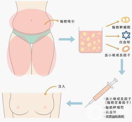 自體脂肪隆胸價(jià)格 自體脂肪豐胸后的危害