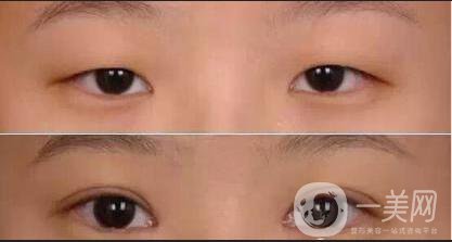 上瞼下垂多少錢,上瞼下垂術(shù)后護(hù)理