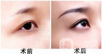 自體脂肪隆眉弓多少錢(qián)