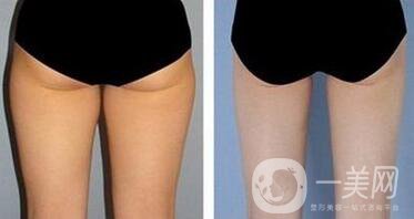 自體脂肪豐臀貴嗎