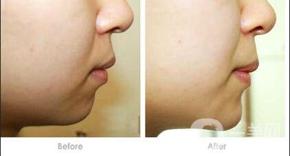 膨體墊下巴貴嗎