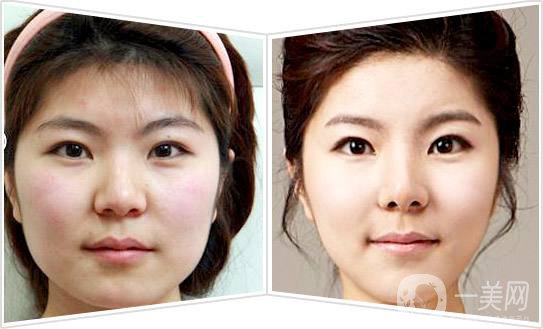 面部吸脂*果圖 面部吸脂注意事項