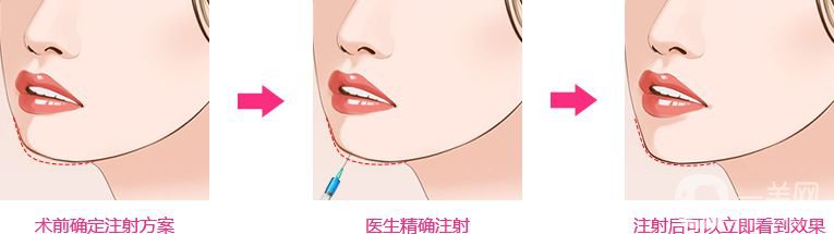 自體脂肪豐下巴貴嗎 豐下巴*果好不好