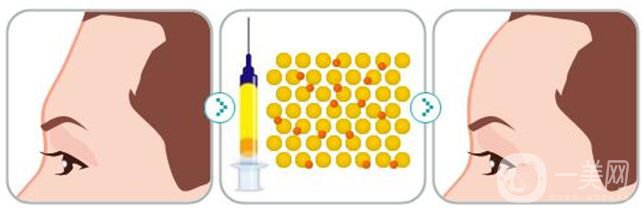 自體脂肪豐額頭貴嗎 影響豐額頭價格的因素