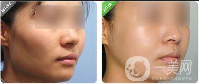 顴骨顴弓貴嗎,顴骨顴弓注意事項