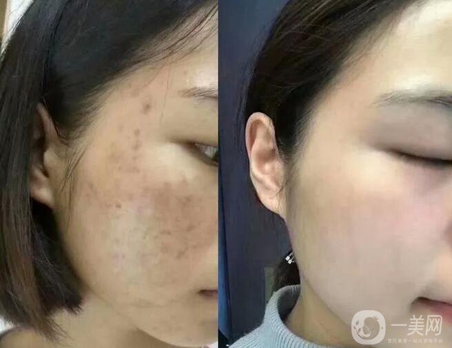 激光祛斑*果,激光祛斑優(yōu)勢