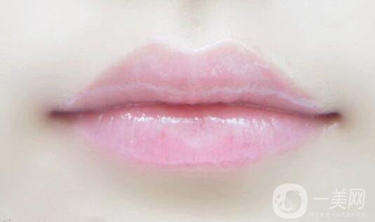 玻尿酸豐唇珠后需注意什么 該如何護(hù)理？