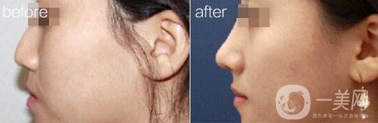 自然隆鼻 哪種隆鼻方式*自然 如何*放心地變美？