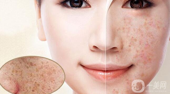 色素沉著如何處理 怎么去除？