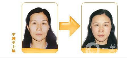 自體脂肪填充面部貴嗎 面部填充手術(shù)*果好不好