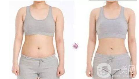 鐳射溶脂怎么樣 鐳射溶脂的功*是什么