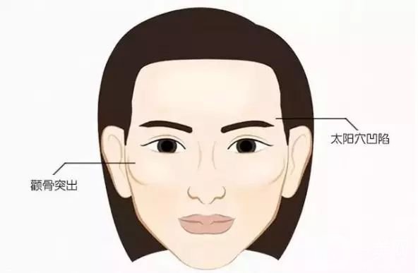 顴骨內推貴嗎 顴骨內推*果好不好