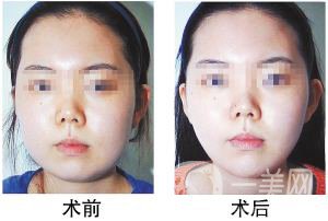 顴骨內推貴嗎 顴骨內推*果好不好