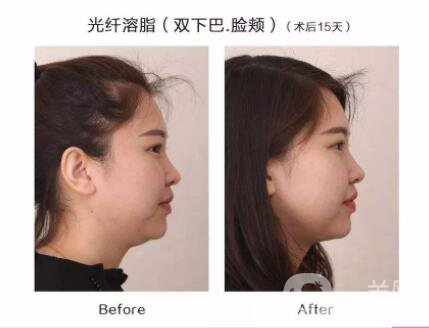 光纖溶脂瘦臉貴嗎 光纖溶脂瘦臉價(jià)格是多少