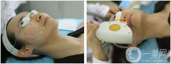 光子嫩膚的原理和作用分別是什么