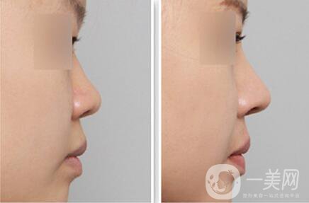 做個(gè)鼻翼縮一次多少錢(qián)