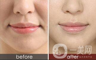 怎樣去鼻唇溝,去鼻唇溝方法