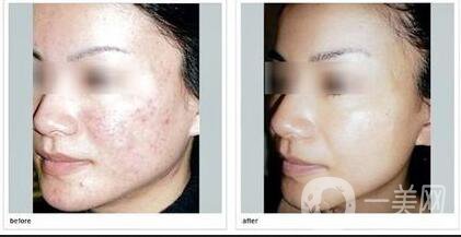 磨皮祛痘坑前后:激光磨皮祛痘坑*果嗎？