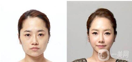 磨腮削骨多少錢 磨腮削骨多久能恢復(fù)