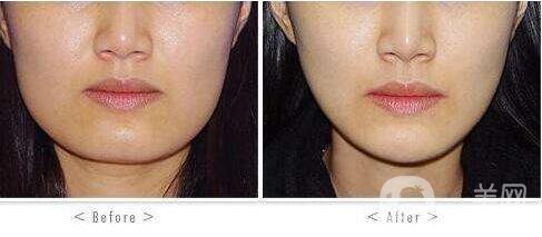 磨腮削骨后遺癥有哪些 磨腮削骨注意事項(xiàng)