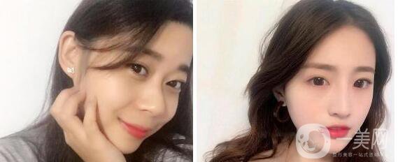 王旭明隆鼻案例 王旭明隆鼻怎么樣