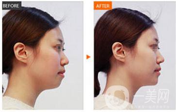 隆鼻失敗是免費(fèi)修復(fù)嗎 隆鼻失敗有后遺癥嗎