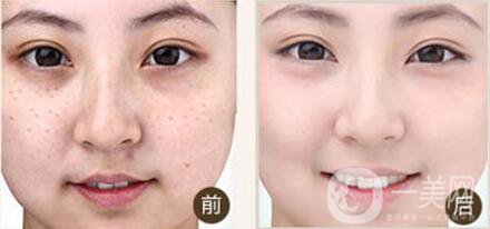 光子嫩膚副作用