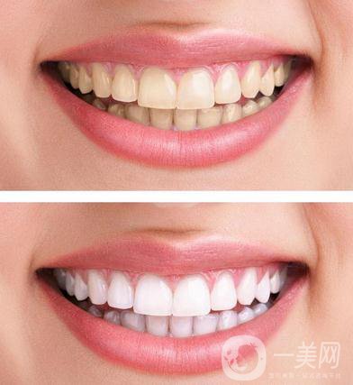 潔牙多少錢(qián) 價(jià)格高嗎？