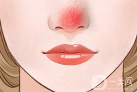 玫瑰痤瘡調(diào)節(jié) 酒糟鼻該怎么辦?