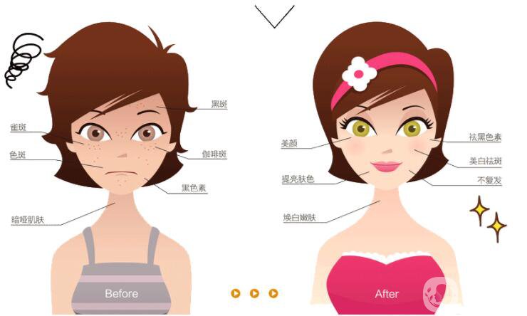 激光祛斑的價格 激光祛斑的*果好不好