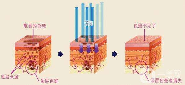 激光祛斑的價格 激光祛斑的*果好不好