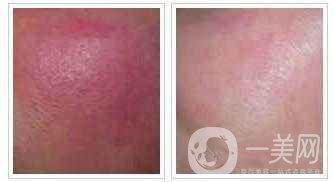 有紅血絲怎么辦 紅血絲如何修復(fù)