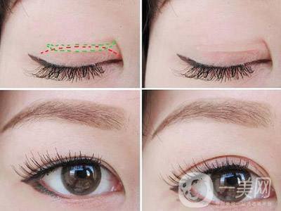 雙眼皮開眼角手術(shù)時間 雙眼皮開眼角痛嗎